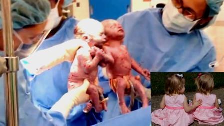 Tvillingene var uatskillelig allerede før fødselen. To år senere er jentene nærmere hverandre enn noensinne!