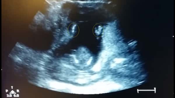 Å se sin ufødte baby på ultralyd er magisk for alle vordende foreldre – men her står stemningen i taket!