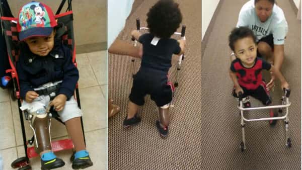 To-åringen måtte amputere begge beina – nå rører han hele verden med sine første skritt!